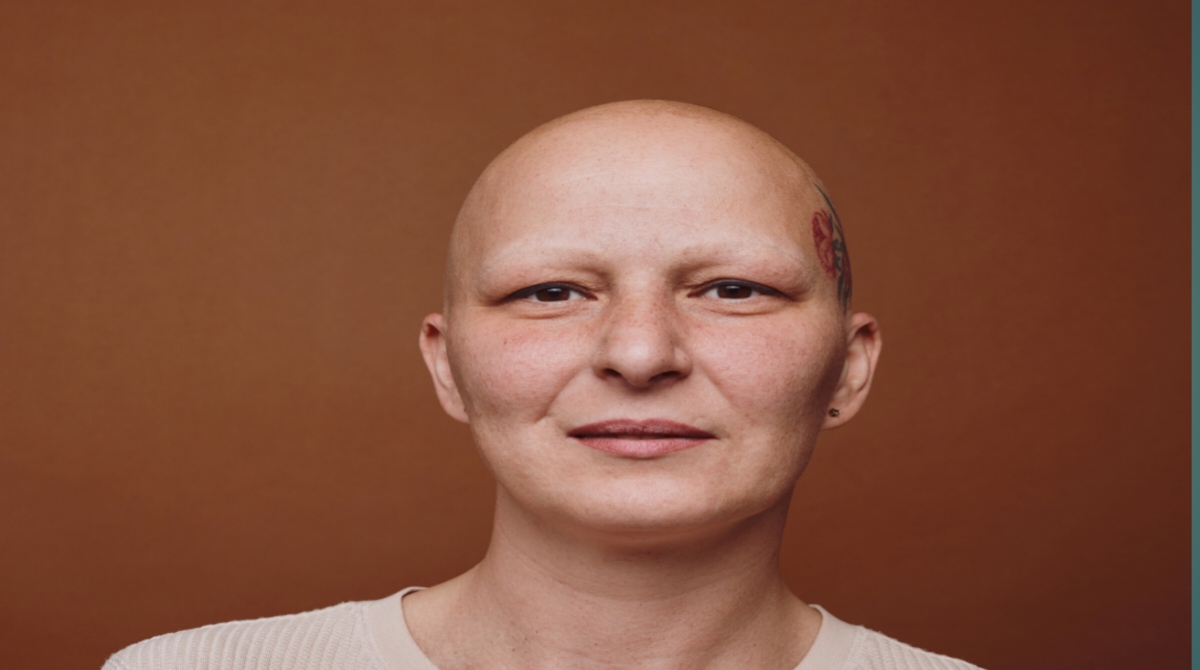 Alopecia 