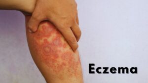 ECZEMA