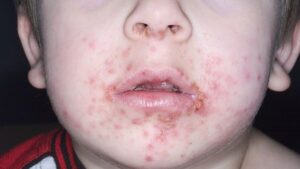 IMPETIGO